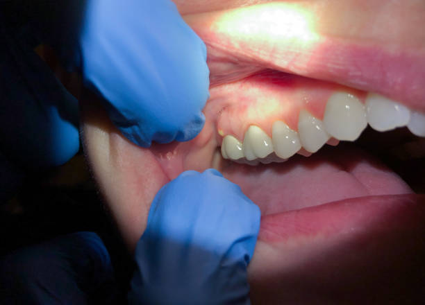 Best Emergency Dental Care for Abscessed Tooth in Rio Verde, AZ
